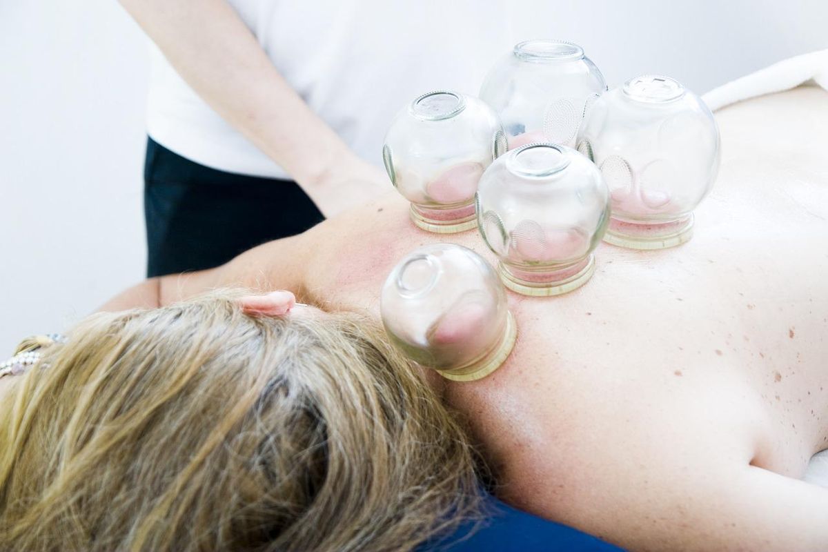 Cupping therapy applied to the back